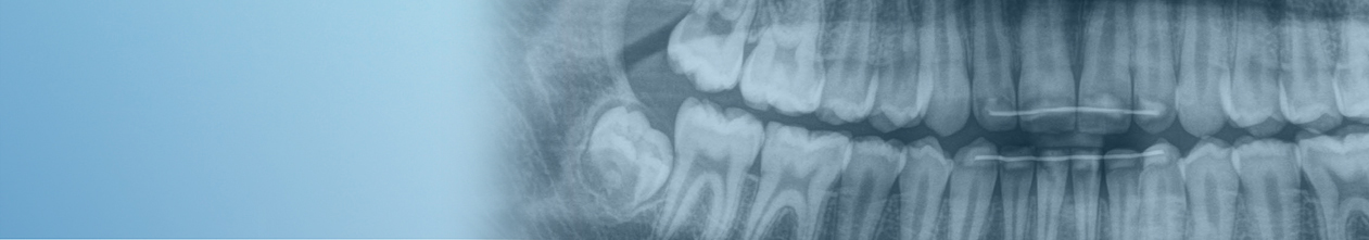 Weisheitszahnentfernung