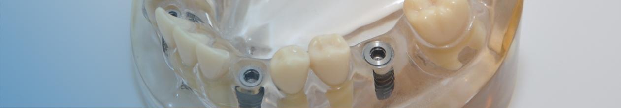 Zahnimplantate